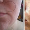 Avantajele peelingului facial cu laser și contraindicațiile procedurii